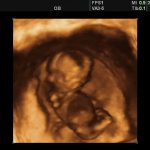 3D УЗИ на 11 неделе беременности