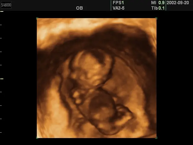 3D ultrasound at 11 weeks of pregnancy