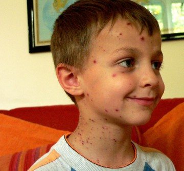 428 138650 360x333 - Dry pimples on the face of a child