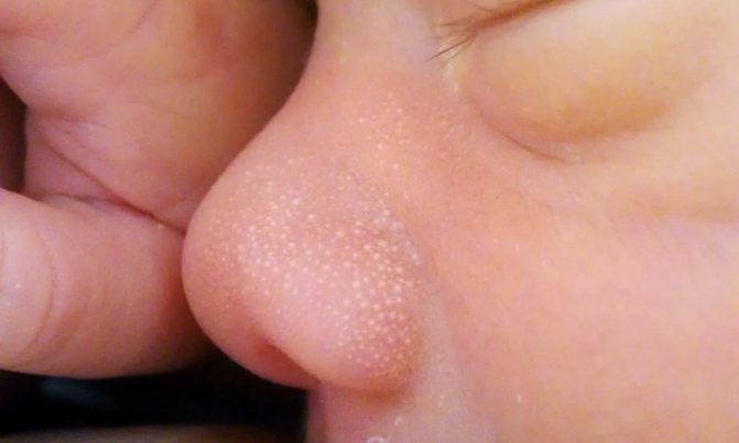 6 most common causes of white pimples on the face of a newborn