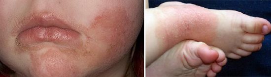 atopic dermatitis signs of lamblia in children