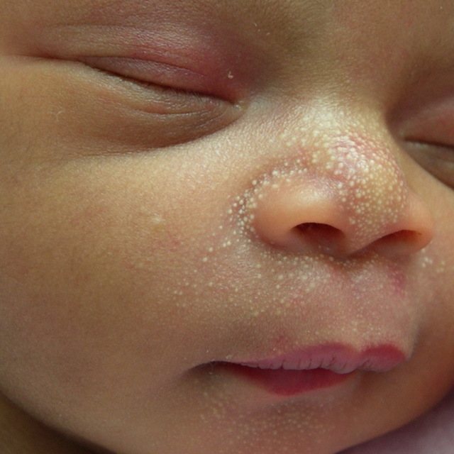 Белые точки на лице у новорожденного: как лечить после родов