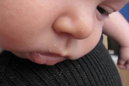 Белые точки на лице у новорожденного: как лечить после родов