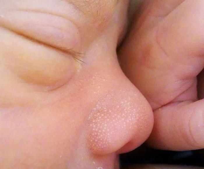 white spots on baby&#39;s nose