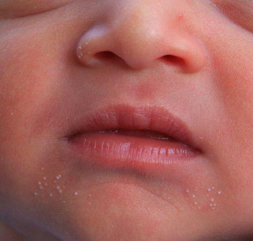 white spots on the nose of a newborn when they go away