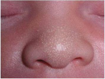white spots on the nose of a newborn