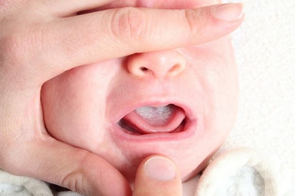 White coating on the tongue, on the cheeks in the mouth of a baby during breastfeeding and bottle-feeding: causes and treatment
