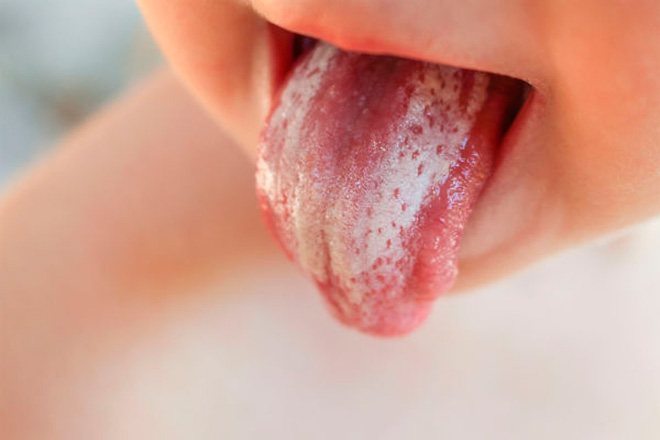 Белый налет на языке у ребенка: почему появляется и что означает?