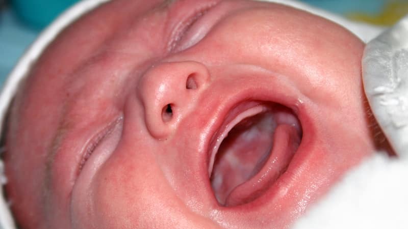 white plaque in a child&#39;s mouth