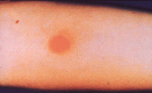 What not to eat if you have Mantoux for tuberculosis. Mantoux test: what is not allowed and what is possible? 