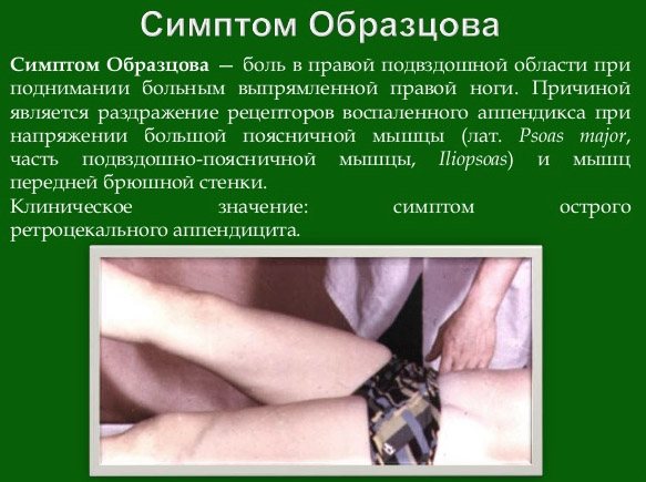 What is Obraztsov&#39;s symptom
