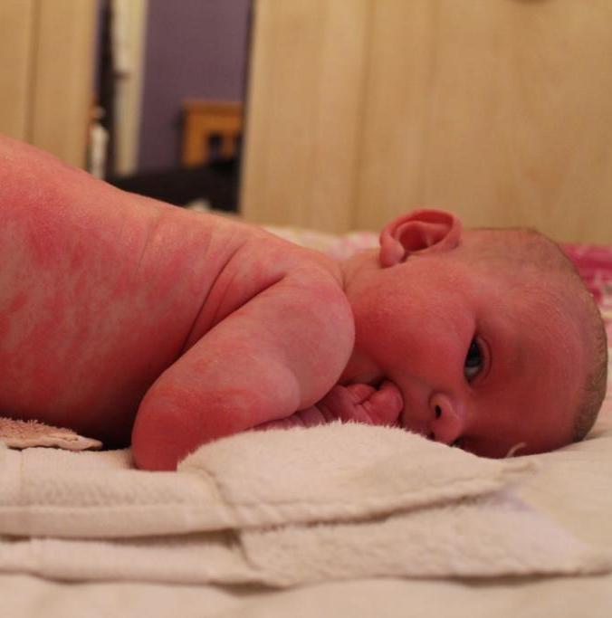 Eczema in a baby