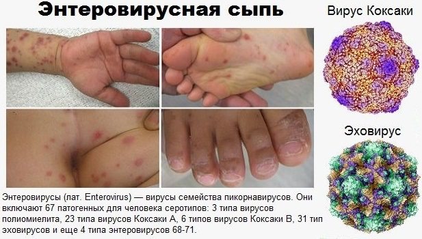 Enterovirus infection in children - symptoms and treatment, photo. How and what to treat skin rashes at home, diet, medications 