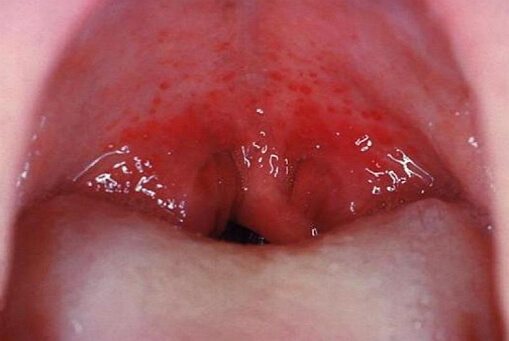 photo of throat with scarlet fever