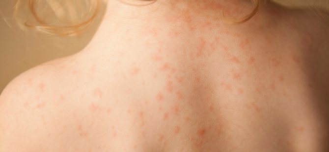 Photo of an allergic rash in a child