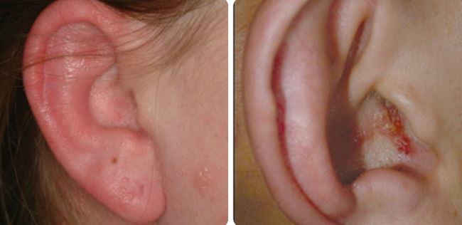 Herpes on the ear