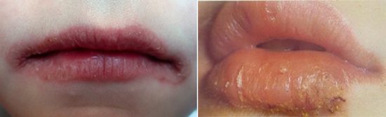 Giardia cheilitis in children