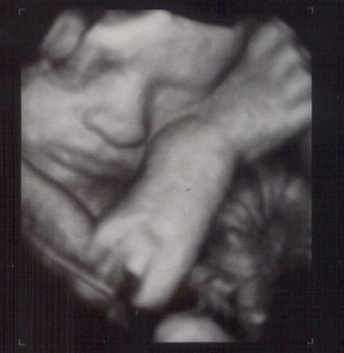 3D ultrasound image of a child