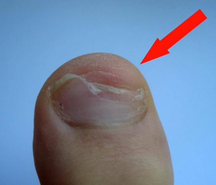 Как лечить слоящиеся ногти на ногах у ребенка?