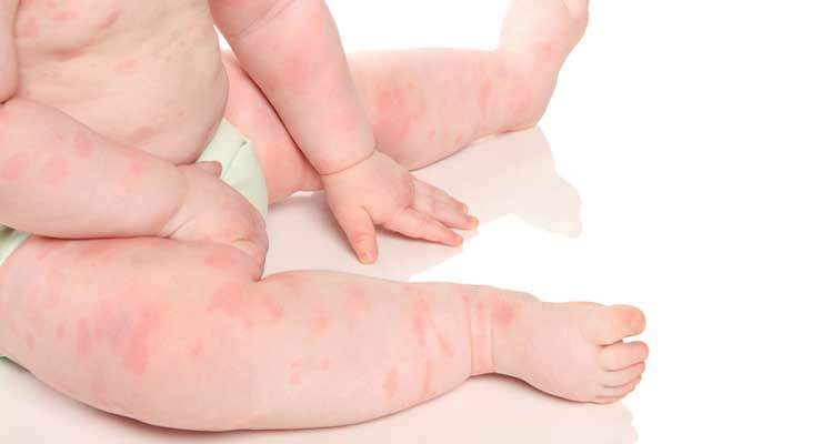 How to cure baby&#39;s skin?
