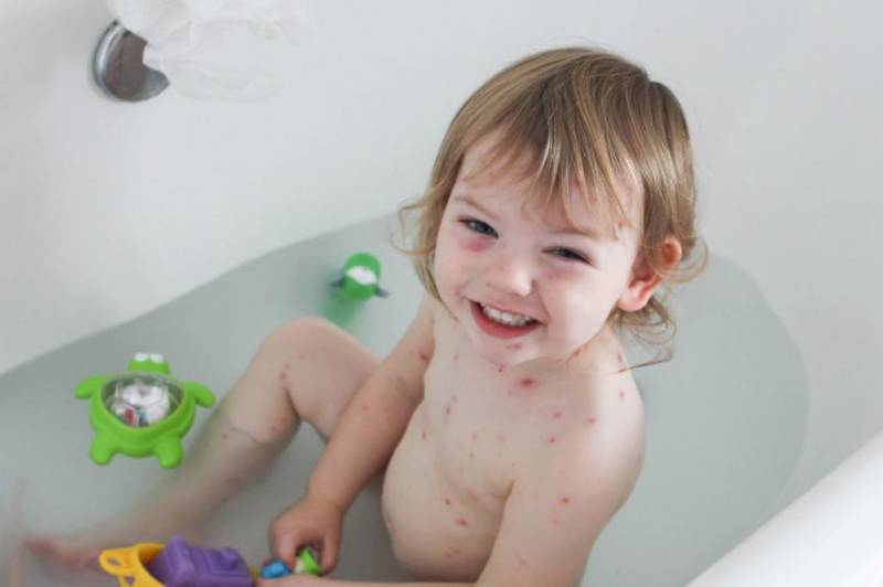 When can you wash with chickenpox: doctor&#39;s recommendations