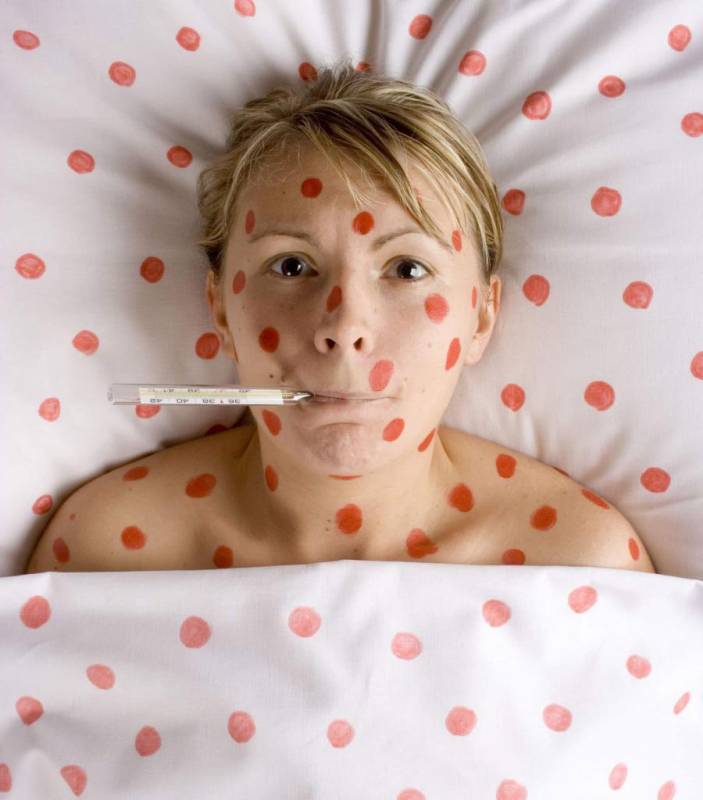 When can you wash with chickenpox: doctor&#39;s recommendations