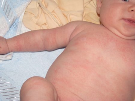 Contact dermatitis on a child&#39;s skin