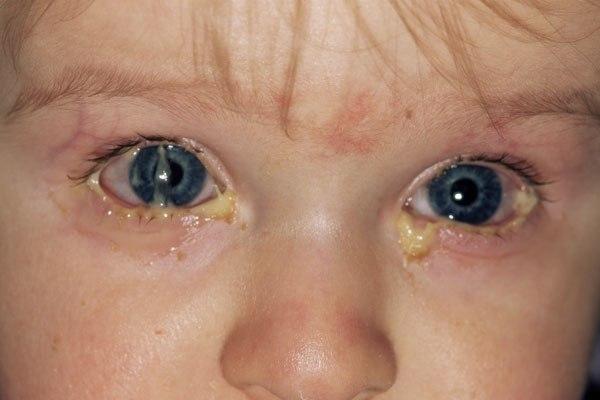 Conjunctivitis in a newborn: how to treat - in detail!