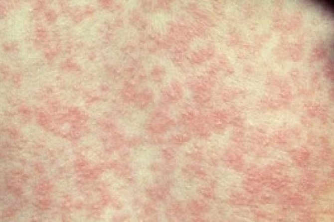 measles photo close up
