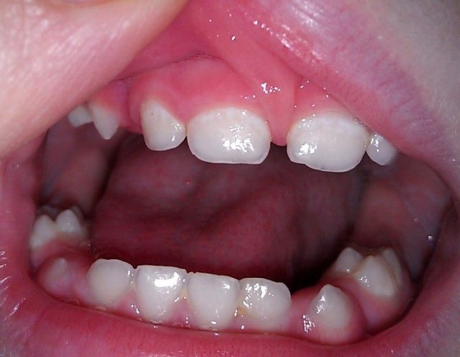 Brown plaque on a child’s teeth: causes, treatment and...