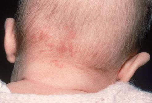 red spots on a child&#39;s neck