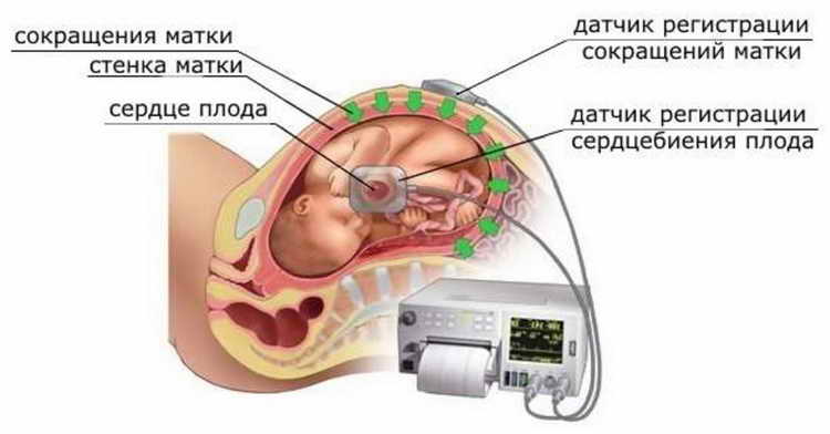 CTG during pregnancy