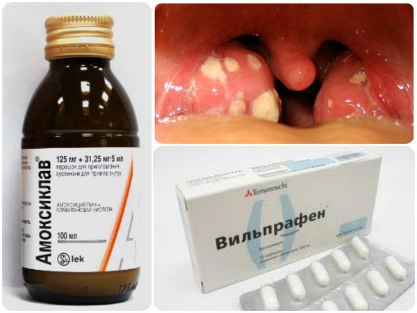 Treatment of follicular sore throat with antibiotics