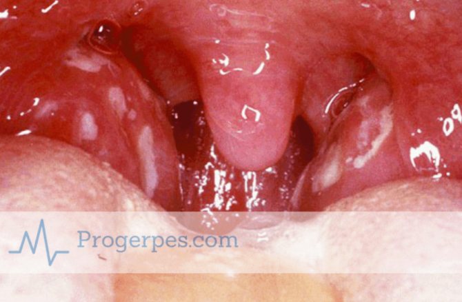treatment of herpetic sore throat in children