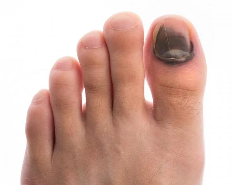 Лечение и профилактика трещин на ногте большого пальца ноги