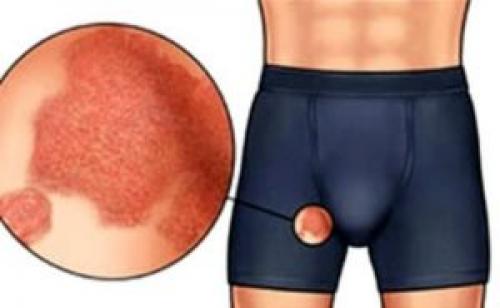 Treatment of diaper rash in the groin in men. Inguinal diaper rash between the legs in adult men 