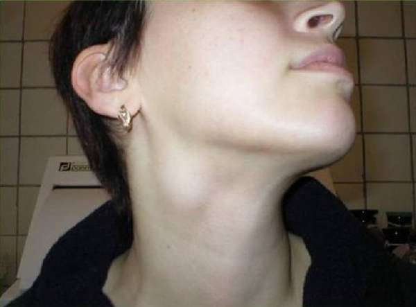 Lymphadenitis on the neck