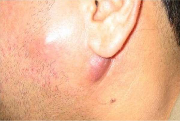 Lymphadenitis behind the ear