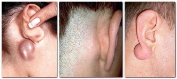 Lymphadenitis behind the ears