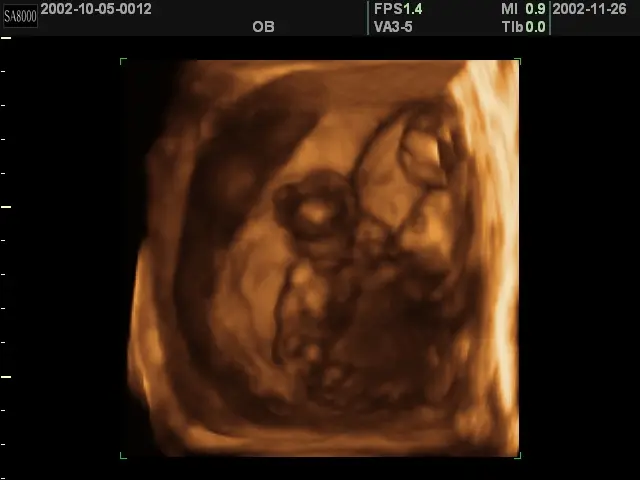 Baby at 8 weeks pregnant