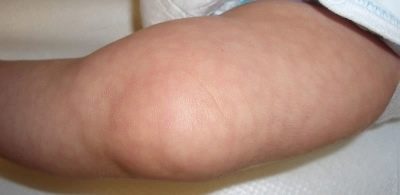 Мраморная кожа у ребенка после года
