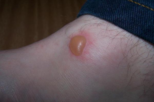 blisters appeared on the leg