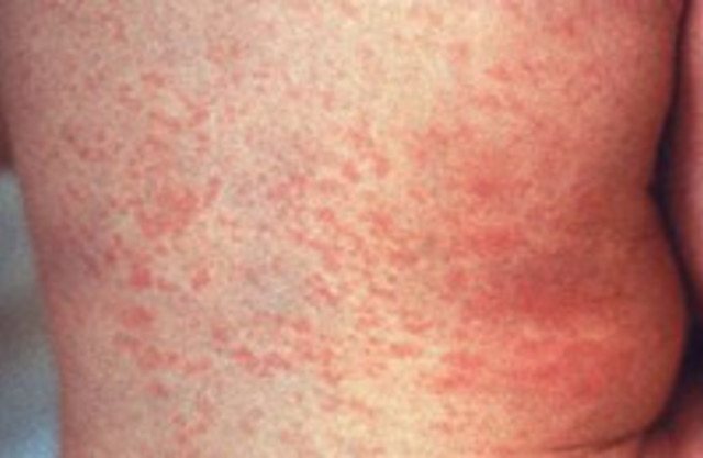 German measles or rubella photo