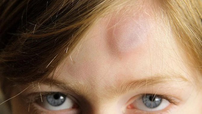 Often, hematomas in the head area occur due to blows
