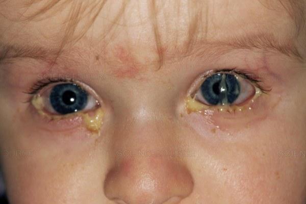 Abundant purulent discharge due to conjunctivitis in a child