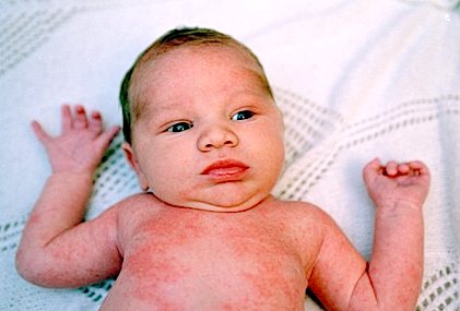 Diaper rash in newborns: how to treat, prevention
