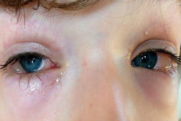 Swelling and hyperemia of the conjunctiva in a child