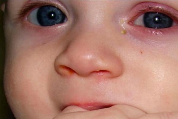Swelling of the eyelids with conjunctivitis in a child