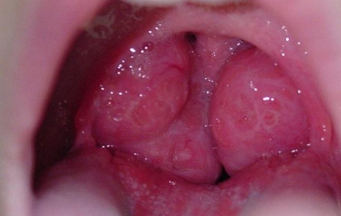 Causes of enlarged tonsils in a child’s throat