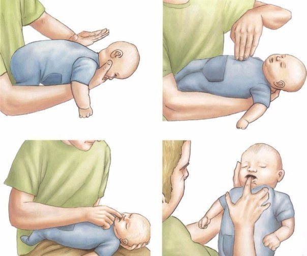 Heimlich maneuver for children